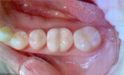 ceramic fillings after treatment 