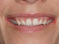 cosmetic dentisry-Cleveland Smiles 
