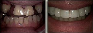 tooth replacement