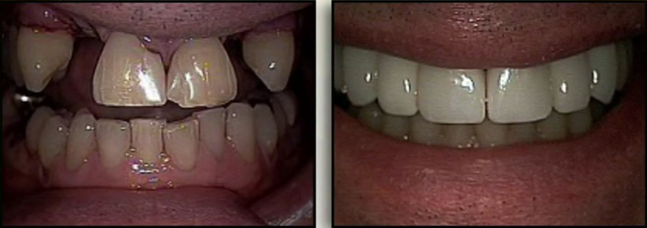 Cleveland tooth replacement