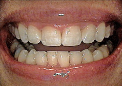 After-Tooth Reshaping