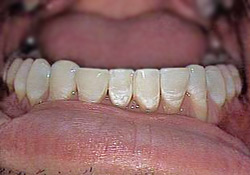 After-Teeth Reshaping - Bottom 