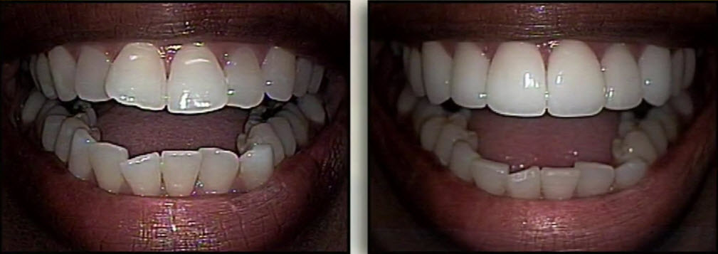 cosmetic dentistry before and after 2