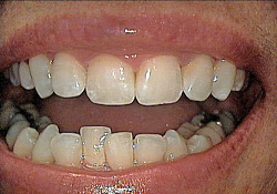 Before-Tooth Reshaping