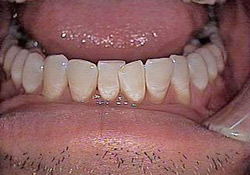 Before-Teeth Reshaping - Bottom 