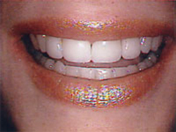 dental bonding cleveland smiles