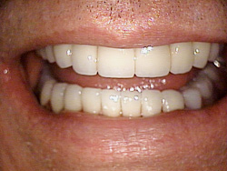 After-Dental Bridges