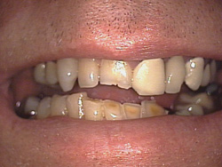 Before-Dental Bridges