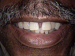 Before-Dental Bridges