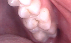 After-Ceramic Fillings