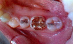 Before-Ceramic Fillings