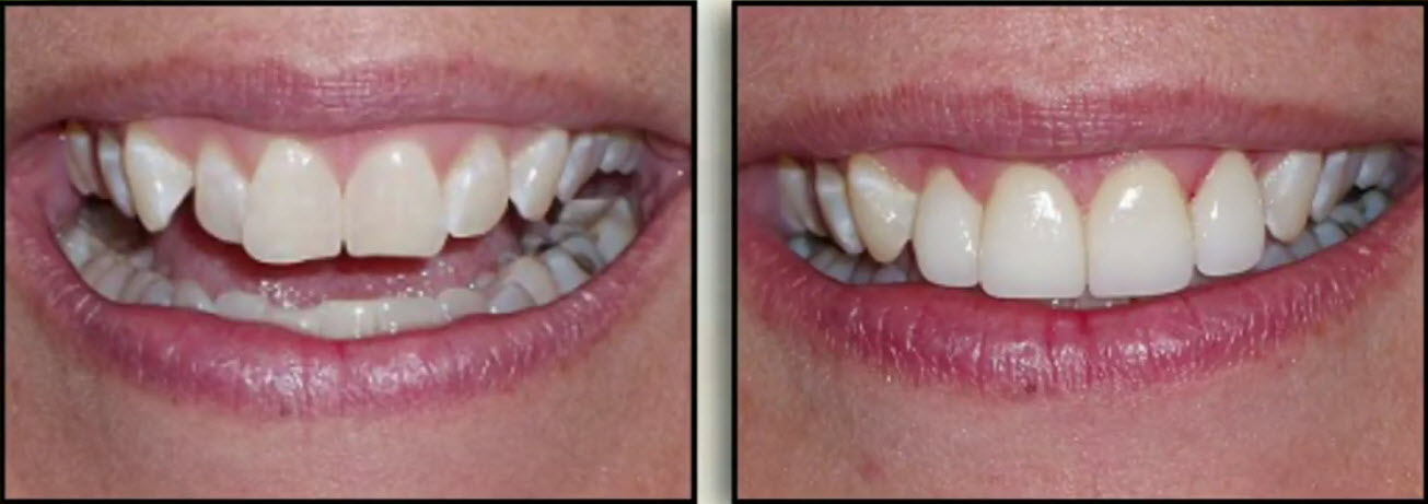 cleveland cosmetic dentistry before and after