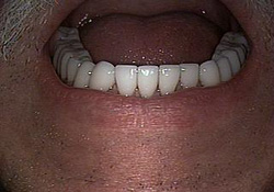 After-Dental Crowns