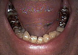 Before-Dental Crowns