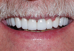dental crowns after