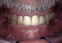 Before-Dental Crowns