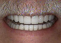 After-Dental Crowns