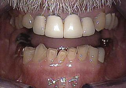 Before-Dental Crowns