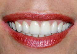 After-Veneers & Gum Lift