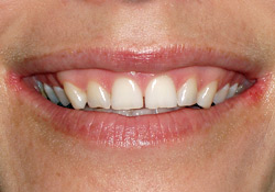 Before-Gum Contouring & Veneers 