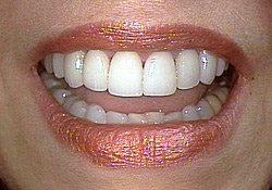 After-Gum Contouring