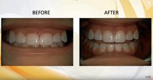 gummy smile before and after
