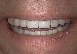 After-Dental Implants