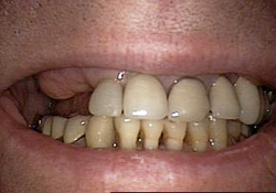 Before-Dental Implants