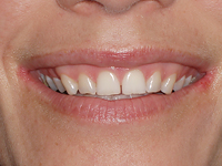 cosmetic dentisry-Cleveland Smiles