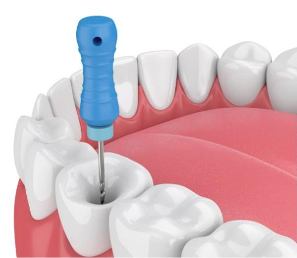 root canal procedure - dr. steve marsh 