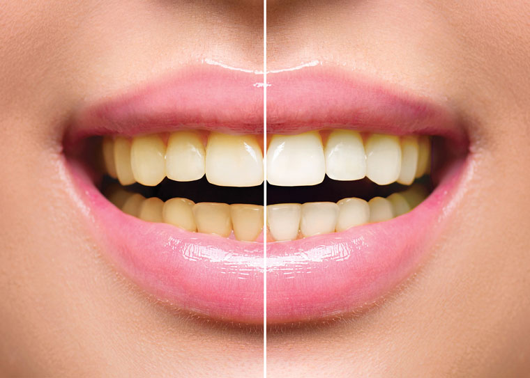 Cleveland teeth whitening 