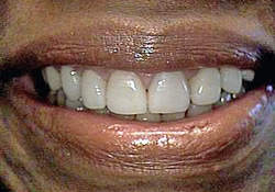 After-Porcelain Veneers