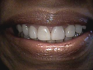 After-Porcelain Veneers