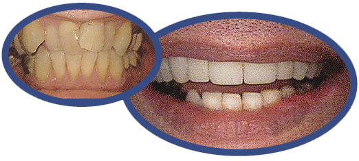 veneers and crowns before and after