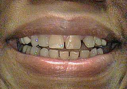 Before-Porcelain Veneers