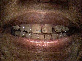 Before-Porcelain Veneers