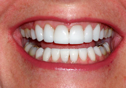 After-Porcelain Veneers