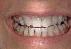 Before-Porcelain Veneers