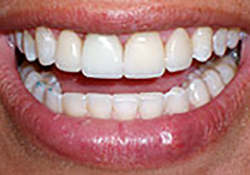 After-Dental Implants