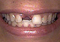 Before-Dental Implants