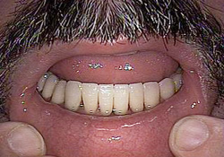 After-Porcelain Veneers