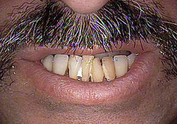 Before-Porcelain Veneers