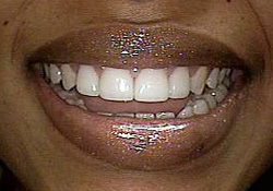 cosmetic dental veneers
