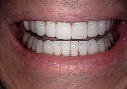 cleveland smiles-dental veneers after