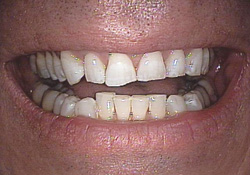 Before-Porcelain Veneers