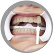 Before Zoom Whitening